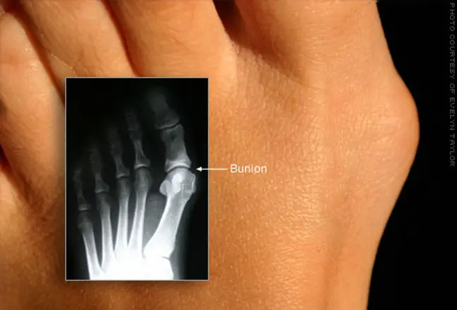 Photo of bunion with inset X-ray image
