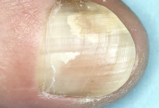 Photo of toenail with fungal infection
