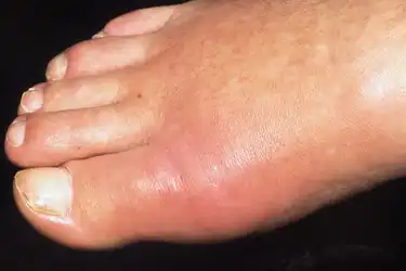 Pictures Of Common Foot Problems