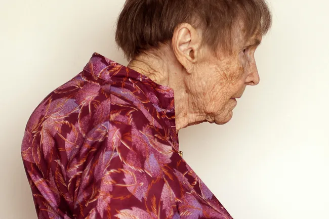 senior woman with kyphosis