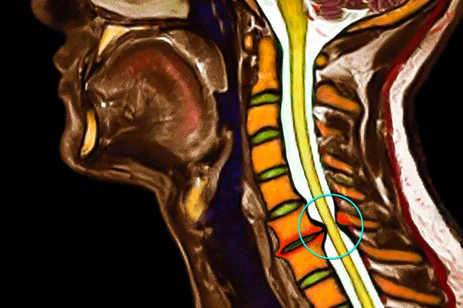 1800ss_science_source_rm_spinal_stenosis
