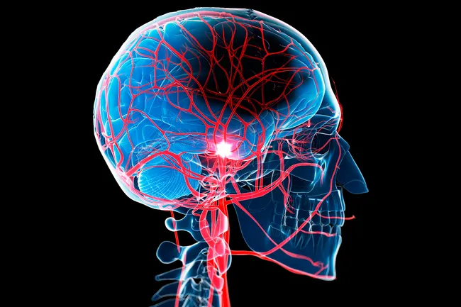 illustration of stroke in brain