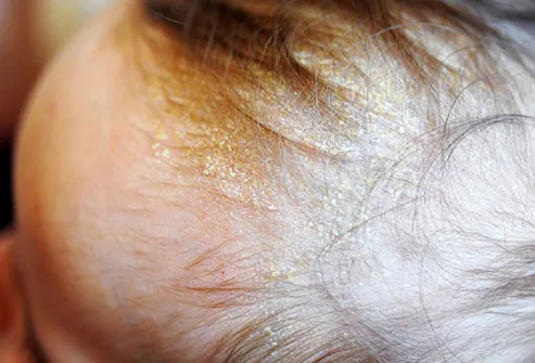 Pictures of Conditions That Affect Your Scalp