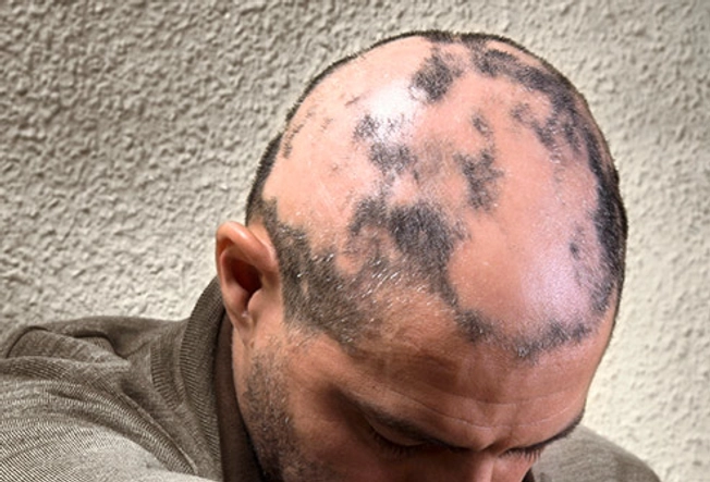 Alopecia Erecta