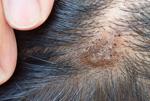 Pictures: Conditions That Affect Your Scalp
