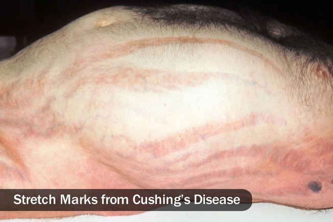 Cushing’s Disease