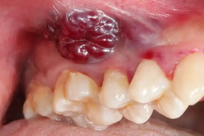 oral kaposis sarcoma