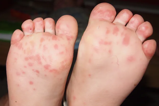 Pictures Of 10 Contagious Skin Rashes