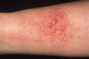 Pictures Of 10 Contagious Skin Rashes