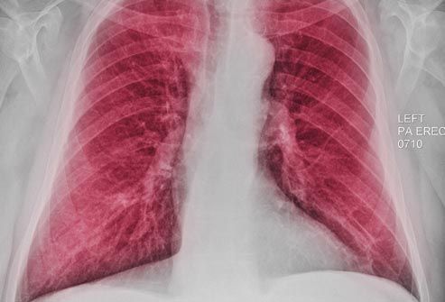 chest xray showing copd