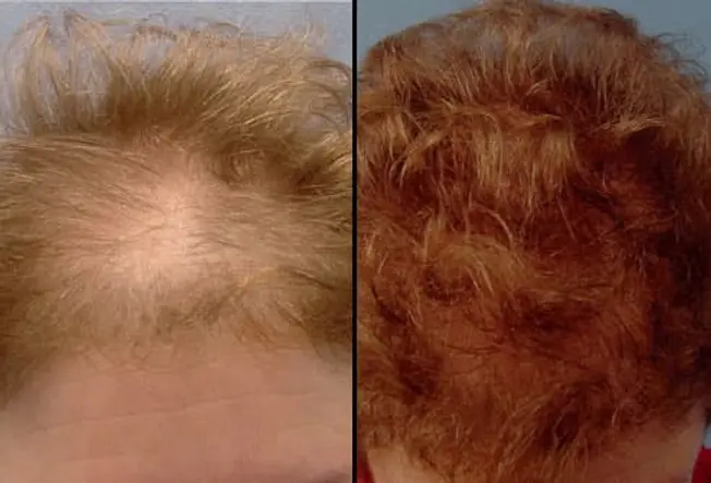 Hair Transplant: Before and After