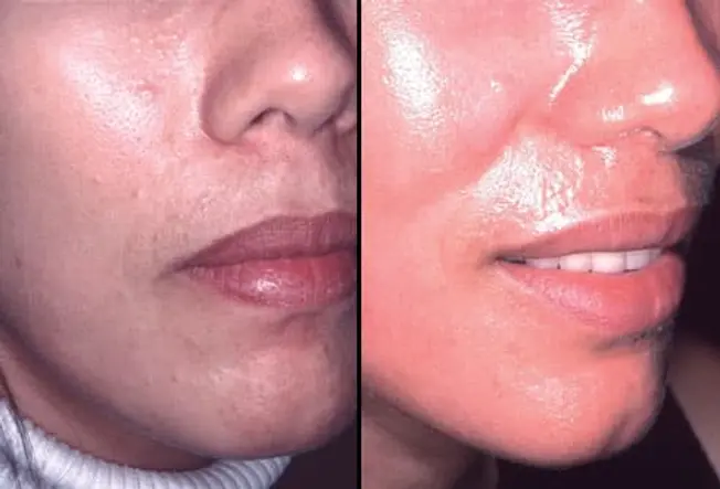 Laser Skin Resurfacing: Before and After