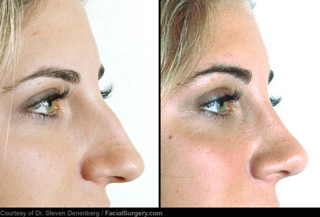 Nose Job: Before and After
