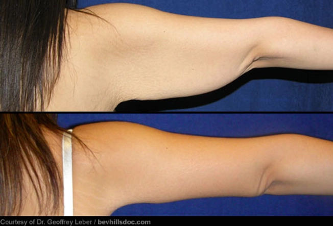 Arm Lift: Before and After