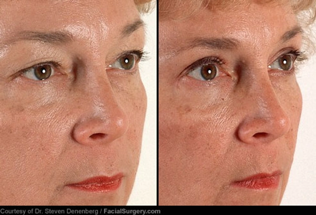 Eyelid Surgery: Before and After