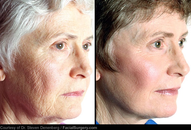 Neck Lift: Before and After
