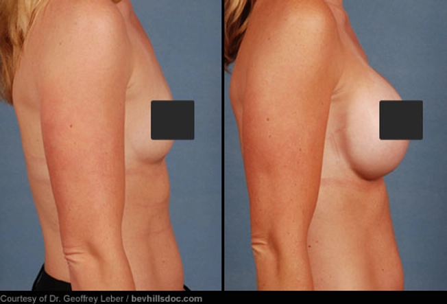 Breast Implants: Before and After