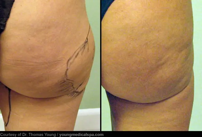 Liposuction: Before and After