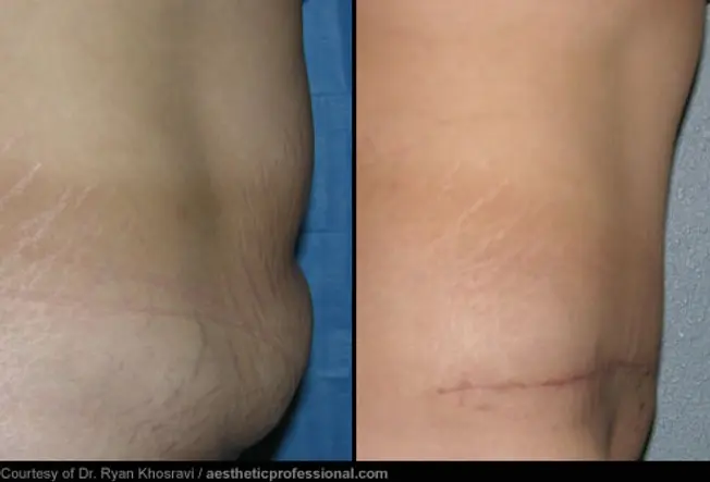 Tummy Tuck: Before and After
