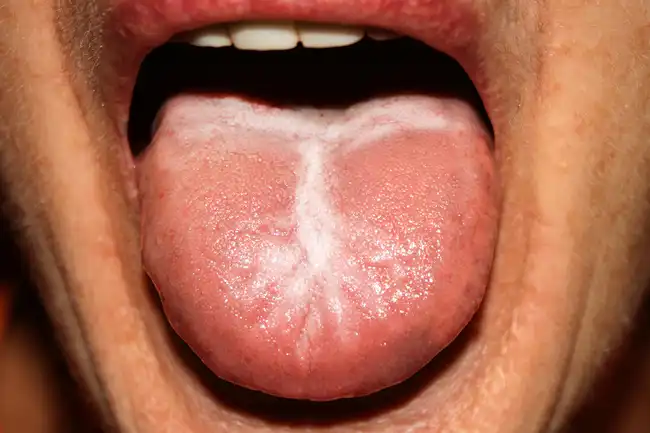candida on tongue