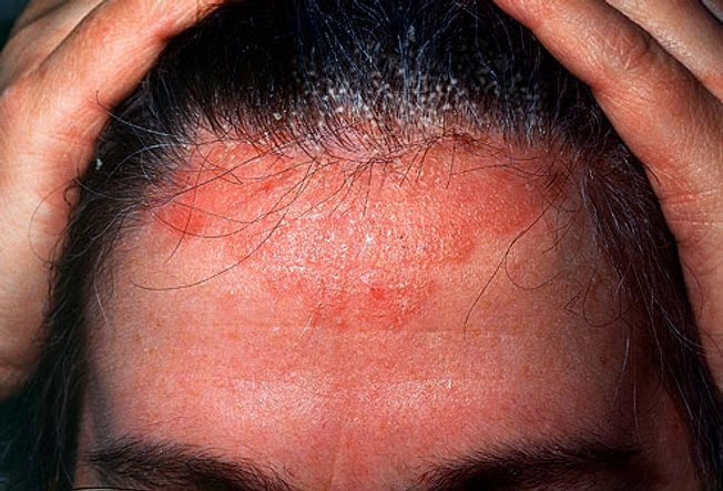 Conditions That Lead to Flaky Scalp