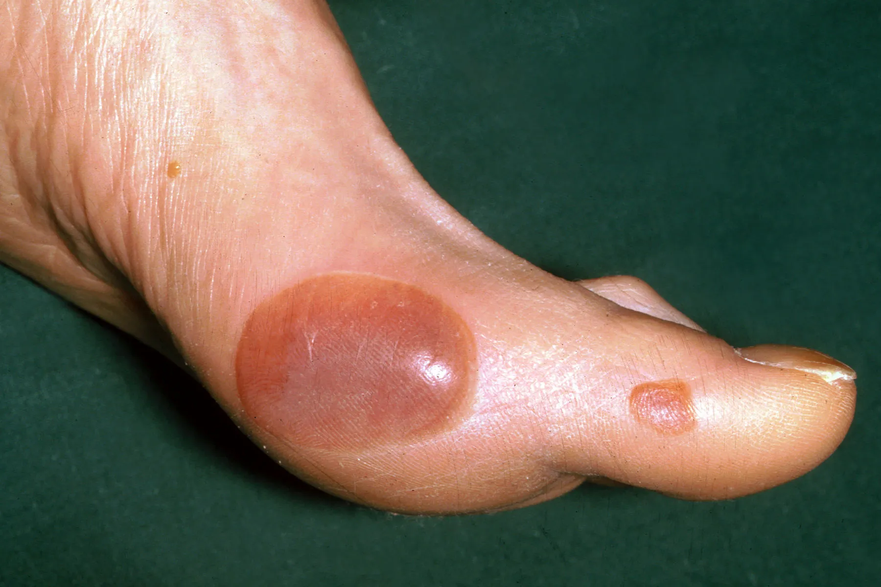 large blister on heel