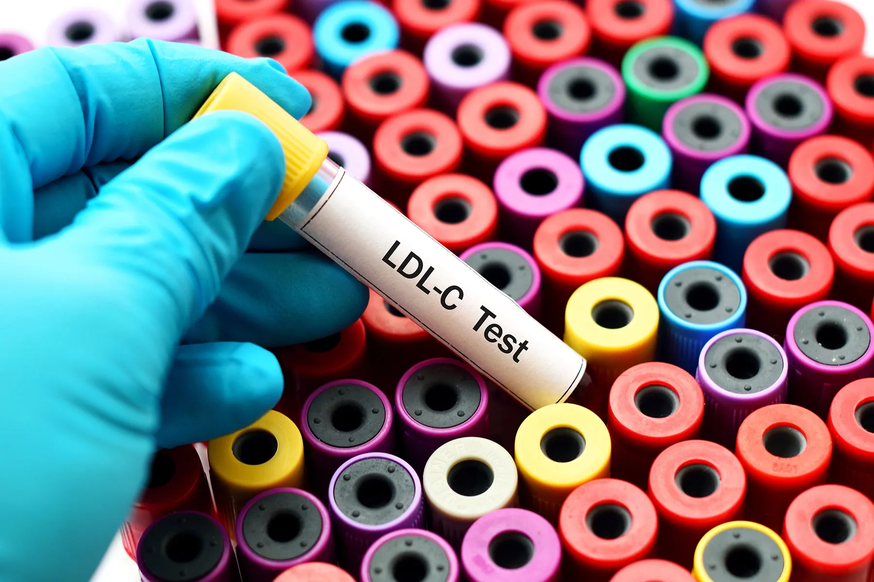 photo of cholesterol test
