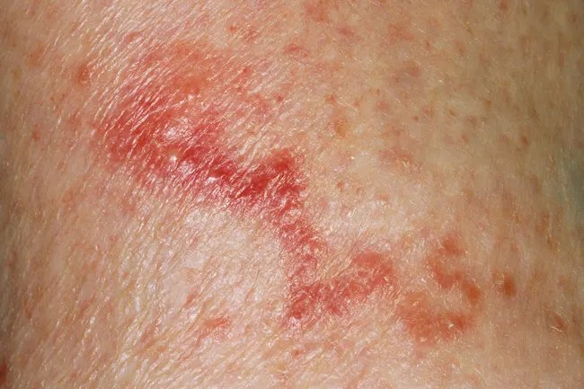photo of hookworm rash