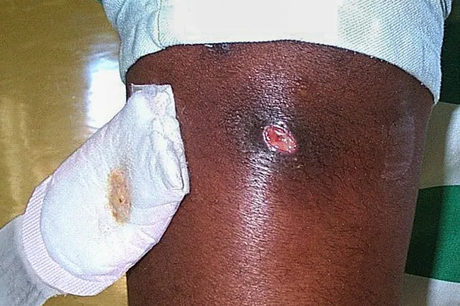 photo of mrsa open wound