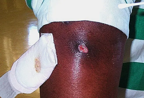 abscess caused by mrsa