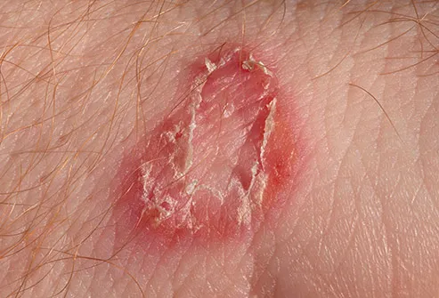 ringworm rash
