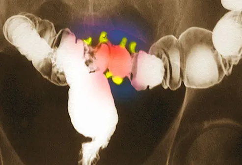 X-Ray of the Colon