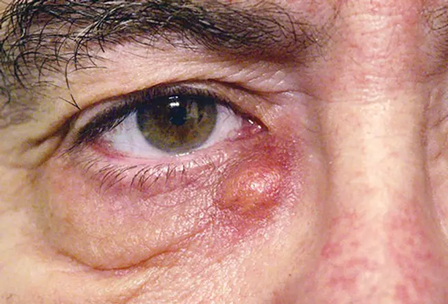 Tear Duct Infection