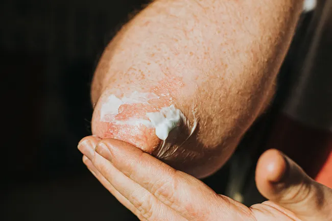 photo of applying cream to elbow