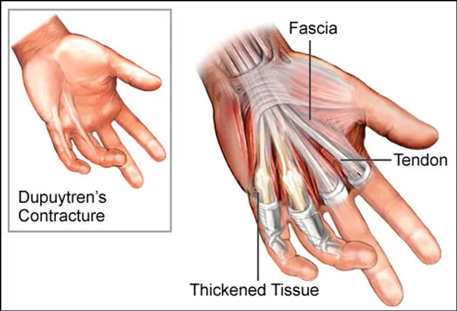 What Is Dupuytren's Contracture?