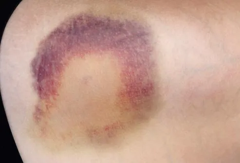 dark spots on skin that look like bruises