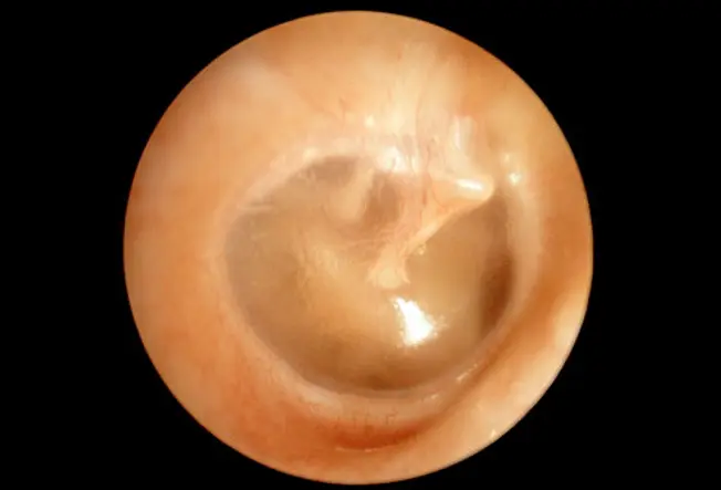 How Doctors Diagnose Ear Infections