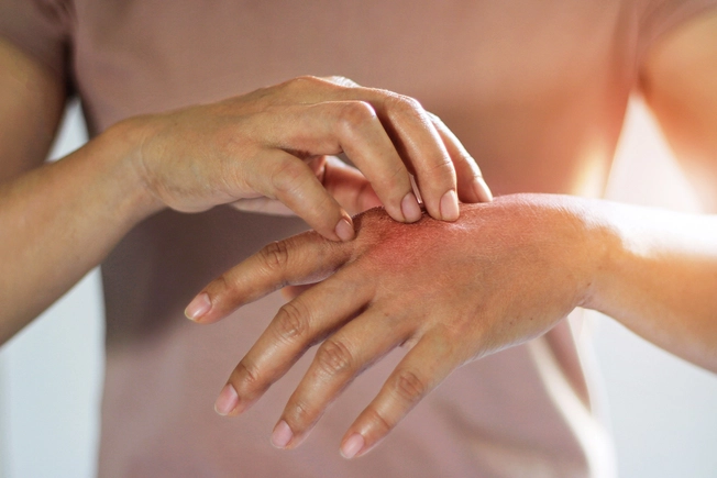 Don’t Ignore Hand Eczema Symptoms