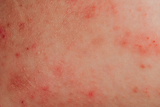 Common Eczemas in Older Adults: Atopic Dermatitis