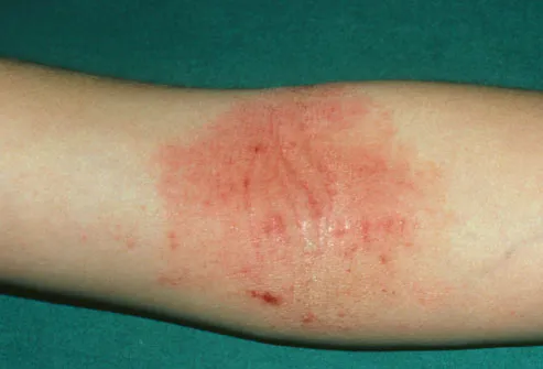 Eczema In Fold Of Elbow