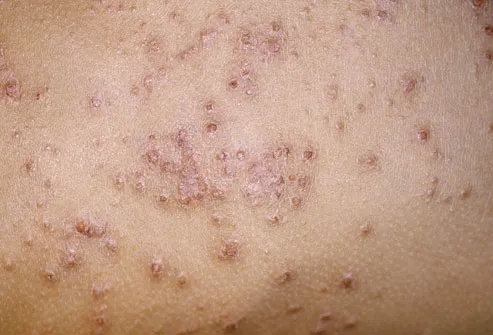 Infected Eczema Rash