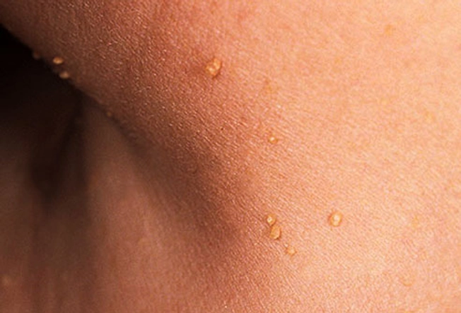 Should I Worry About Skin Tags?