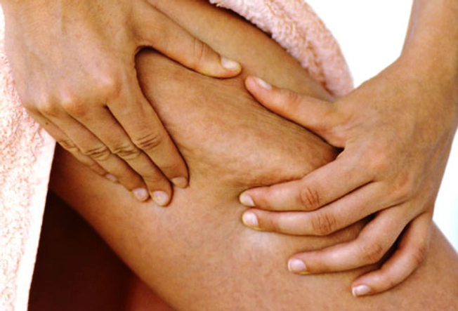 Does Anything Banish Cellulite?