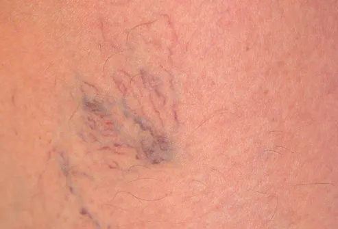 princ rm photo of vericose veins - مشکلات زیبایی:جواب به چند سوال خجالت آور در مورد زیبایی