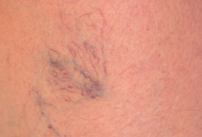 Why Do I Have Spider Veins?