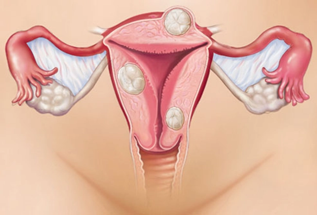 Endometriosis or Fibroids?