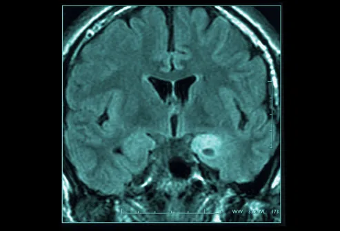 Brain scan showing partial epilepsy