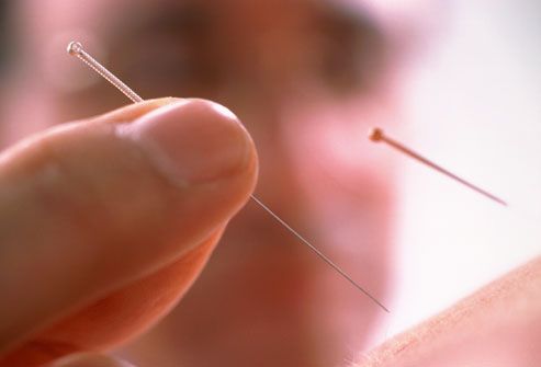 Close up of acupuncture procedure