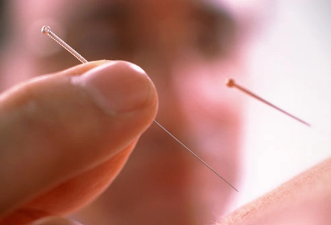 Can acupuncture help fibromyalgia pain?
