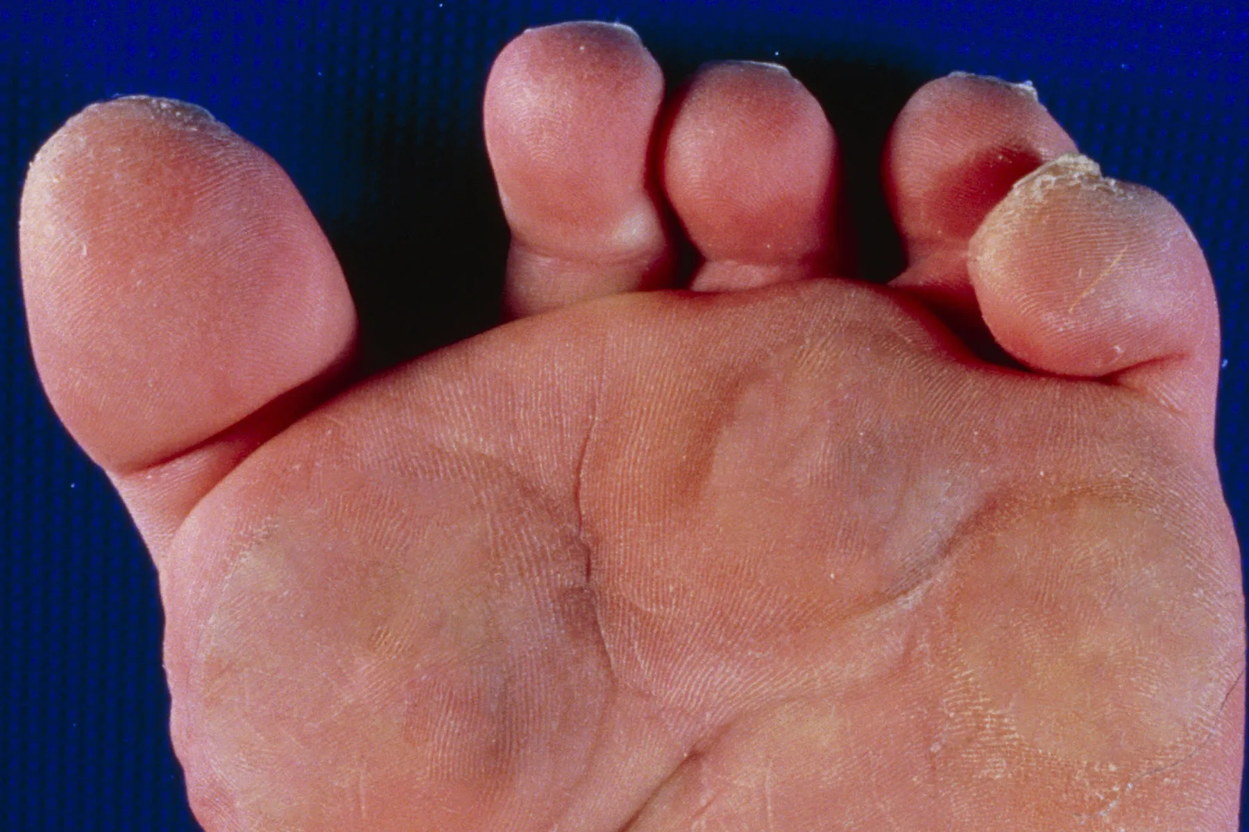cracks under toes